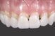 Вініри для верхніх зубів Snap On Smile, професійний, білий A-352 фото 3